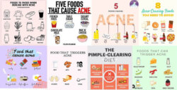 diet acne infographics