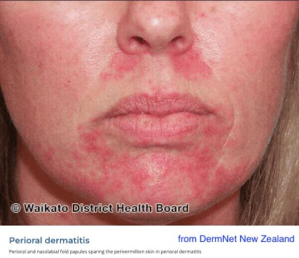 perioral dermatitis